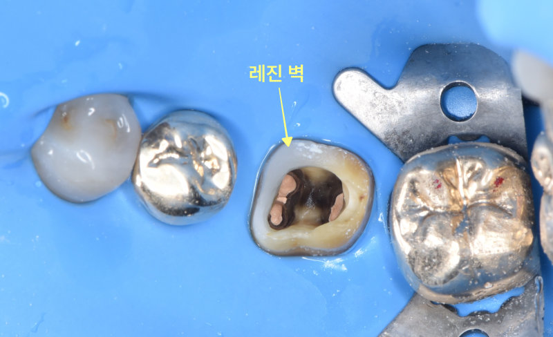 치아에 레진 벽을 세워 신경치료를 준비하는 모습