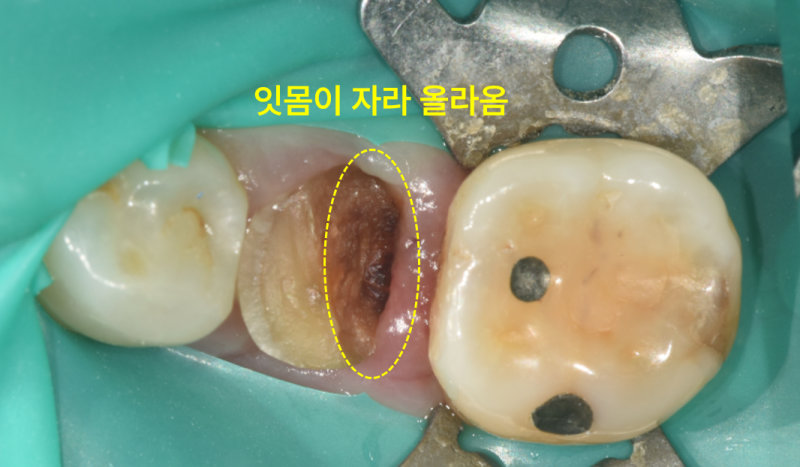 하악 좌측 어금니 파절 부위로 잇몸이 자라 올라온 모습