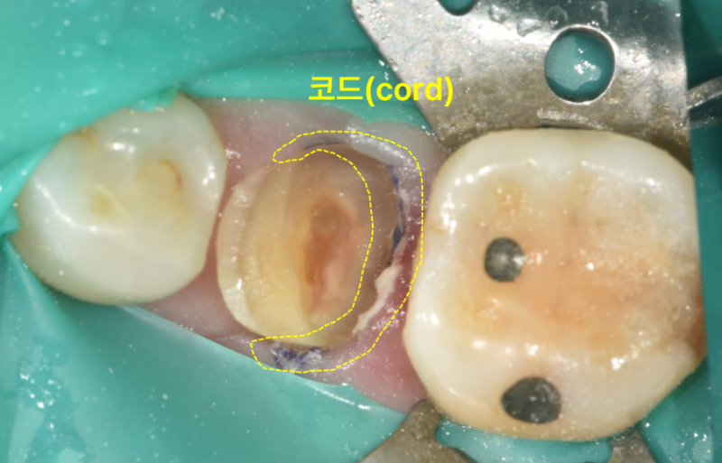 하악 좌측 어금니 파절 부위에 잇몸 압배 코드(cord)를 적용한 모습