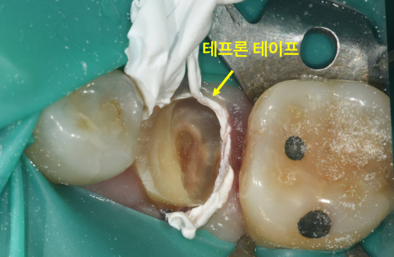 하악 좌측 어금니 파절 부위에 테프론 테이프를 적용한 모습