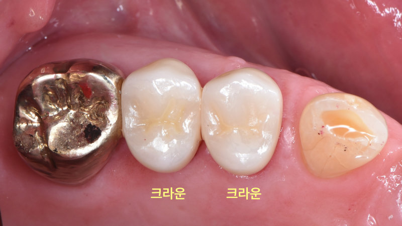 이동치과 임플란트 뼈이식도 보험될까? 관련 사진 14