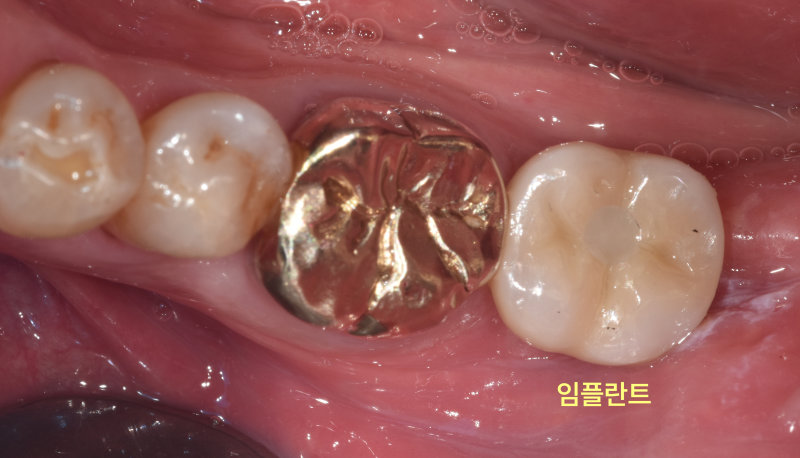 이동치과 임플란트 뼈이식도 보험될까? 관련 사진 16