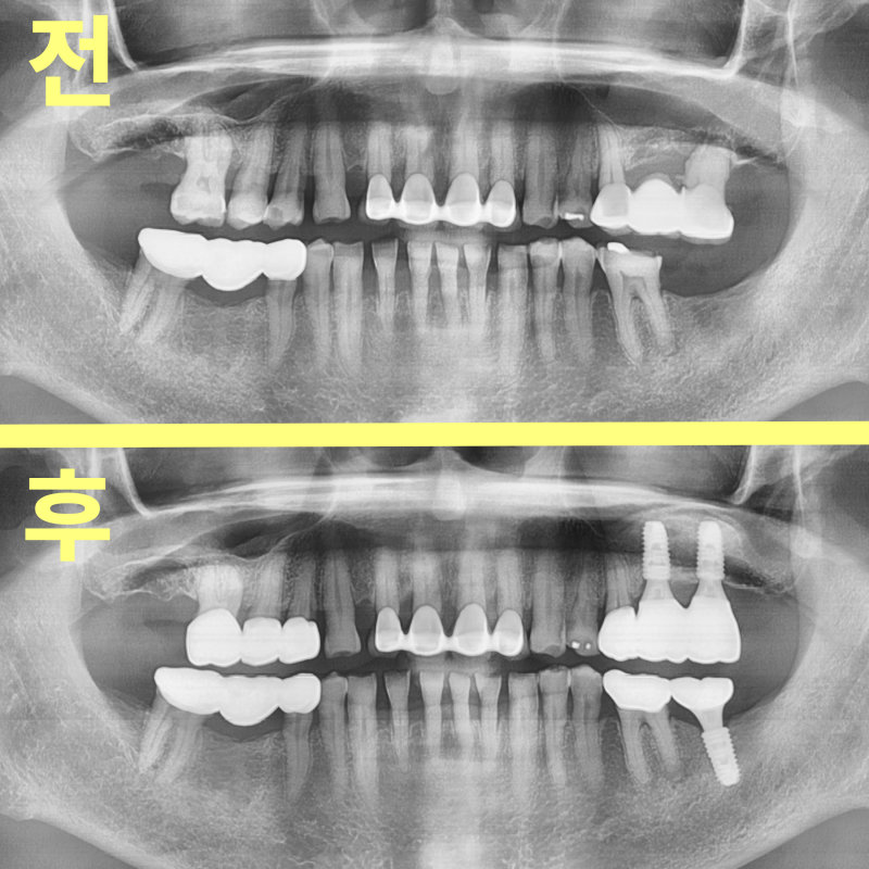 이동치과 임플란트 뼈이식도 보험될까? 관련 사진 17