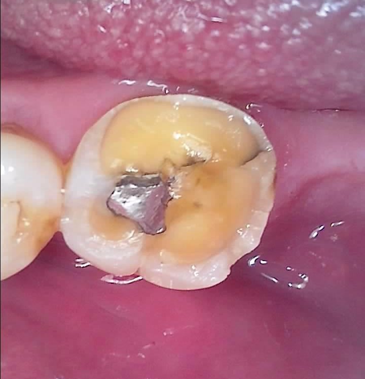 이동치과 임플란트 뼈이식도 보험될까? 관련 사진 6